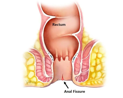 Anal Fissures