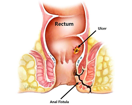 Anal Fistula